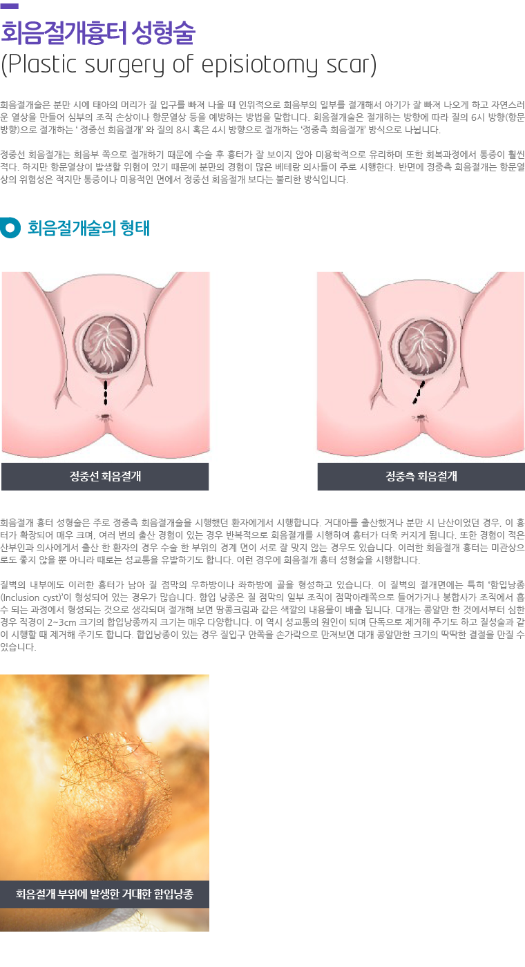 회음절개흉터 성형술