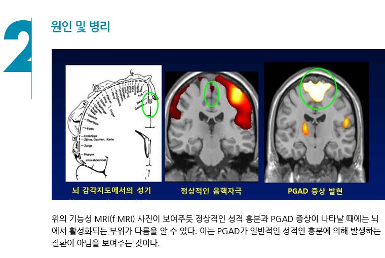지속성생식기흥분장애