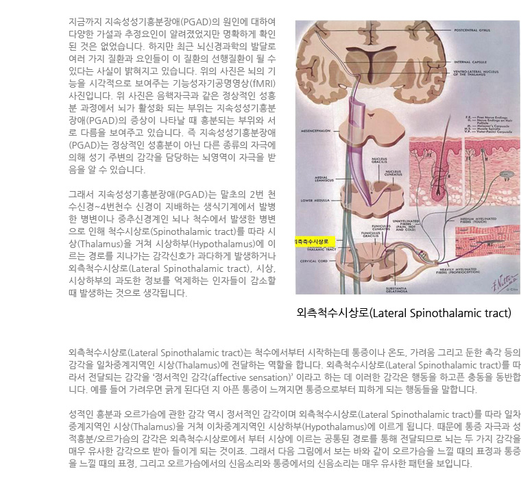Persistent Genital Arousal Disorder, PGAD